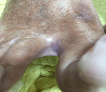 水虫の症状の例　足の指の間　2